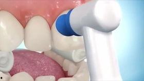 成人牙齿缺失修复视频,跟随视频学习现代修复技术