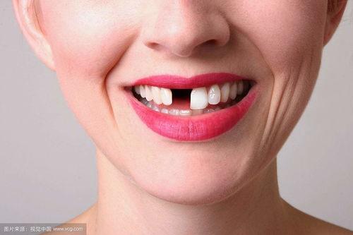 成人牙齿缺失修复视频,跟随视频学习现代修复技术