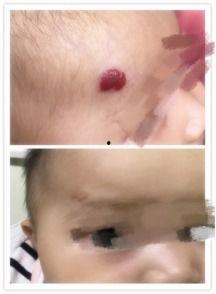 血管瘤成人打针视频,注射疗法操作过程揭秘